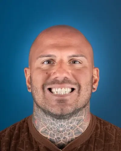 Before treatment — Dental Veneers, 🇮🇹 Italy