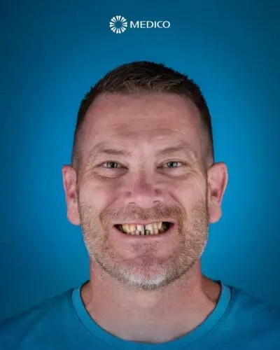 Before treatment — Hollywood Smile, 🇺🇸 United States