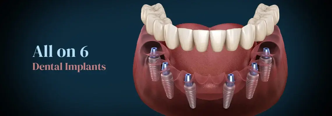 Zygomatic Implants: An Advanced Solution for Severe Bone Loss