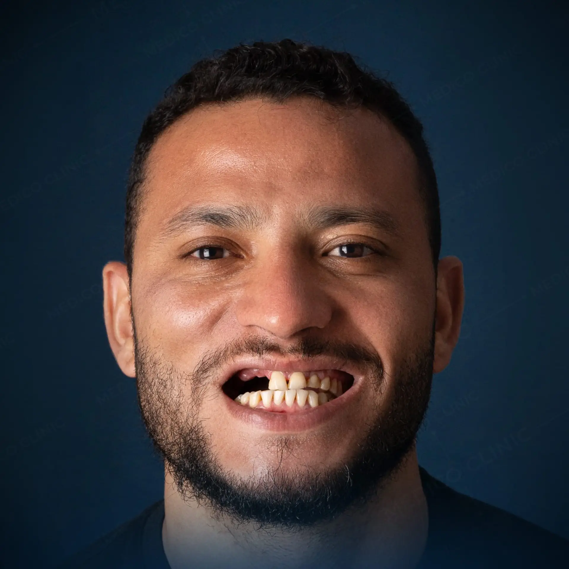 A person with no teeth before dental implants dental