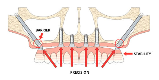 <trp-post-container data-trp-post-id='9575'>Zygomatic Implants: An Advanced Solution for Severe Bone Loss</trp-post-container>