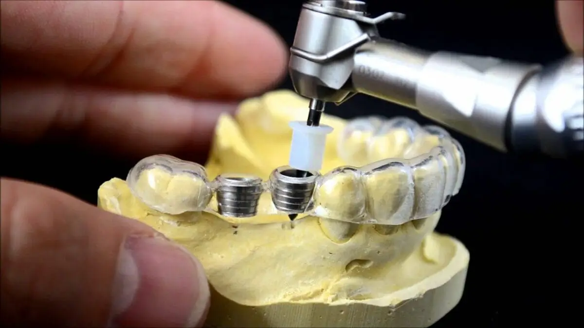 Non-Surgical Dental Implants