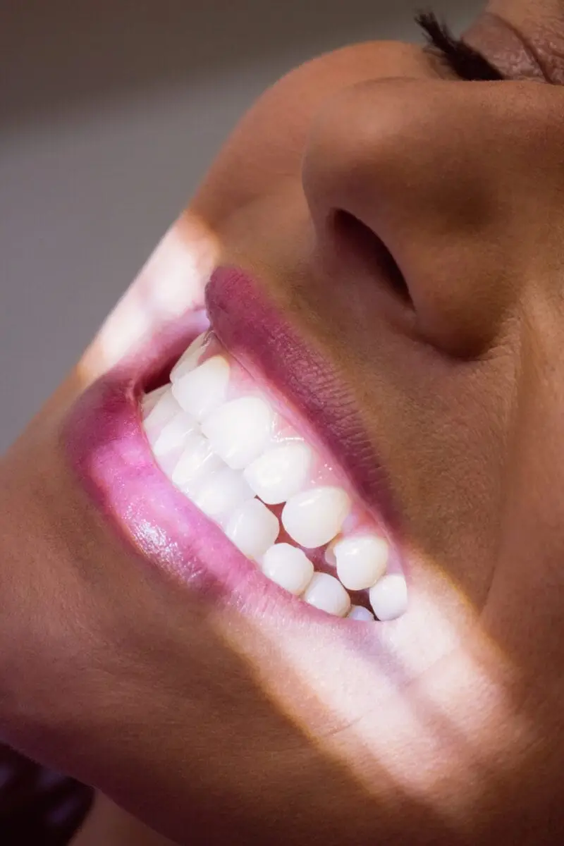 The Truth About Veneers