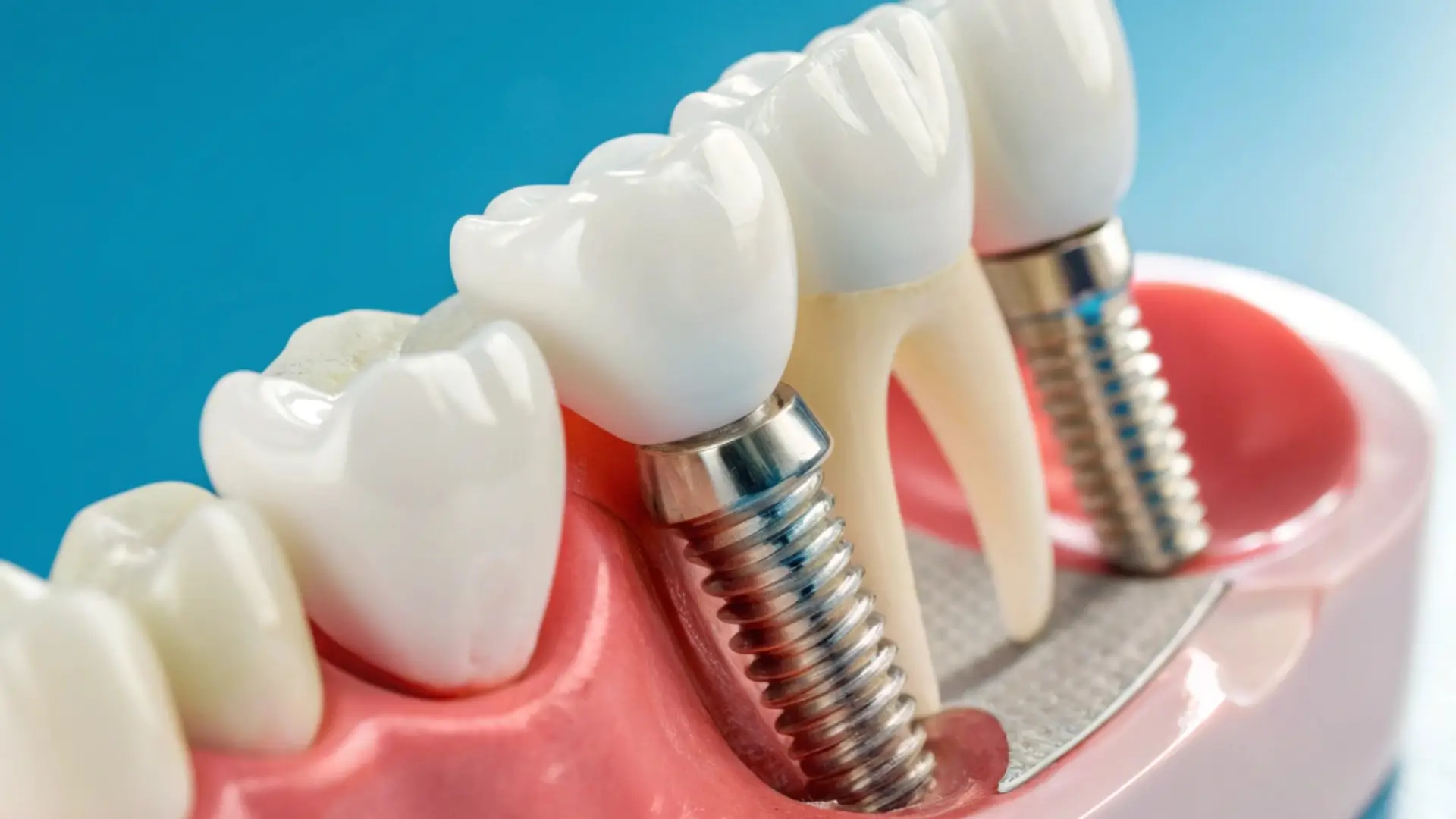 Dental implants