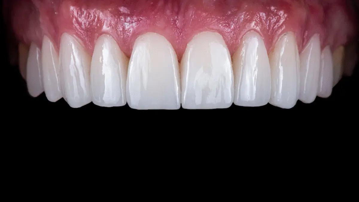 Zirconium vs Veneers