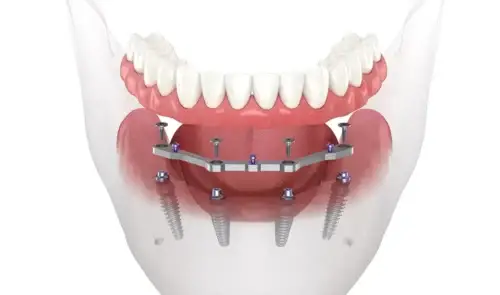 All-on-4 Dental Implant