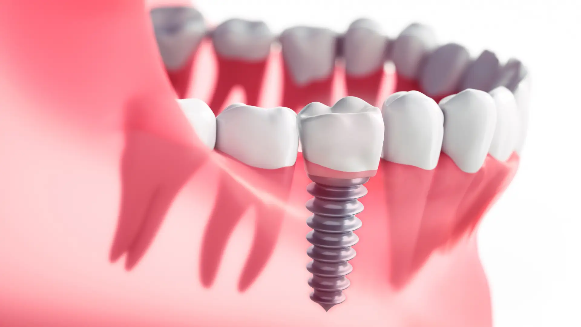 are Dental Implants painful