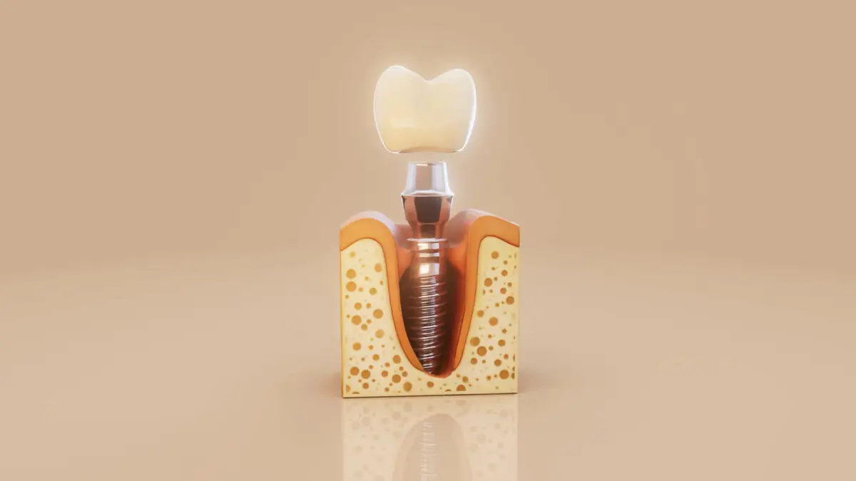 Dental Implant Package