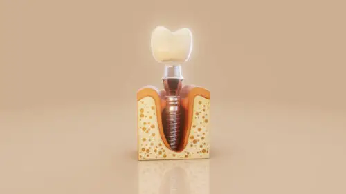 Dental Implant Package