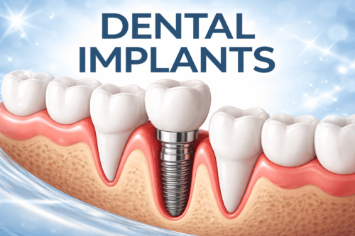 Immediate implants in 2026