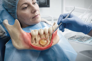 Cyst Removal in Dentistry