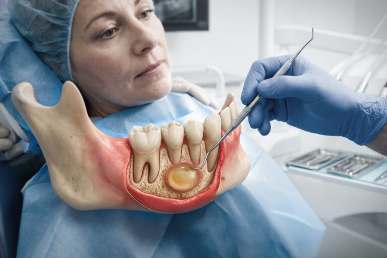 Cyst Removal in Dentistry
