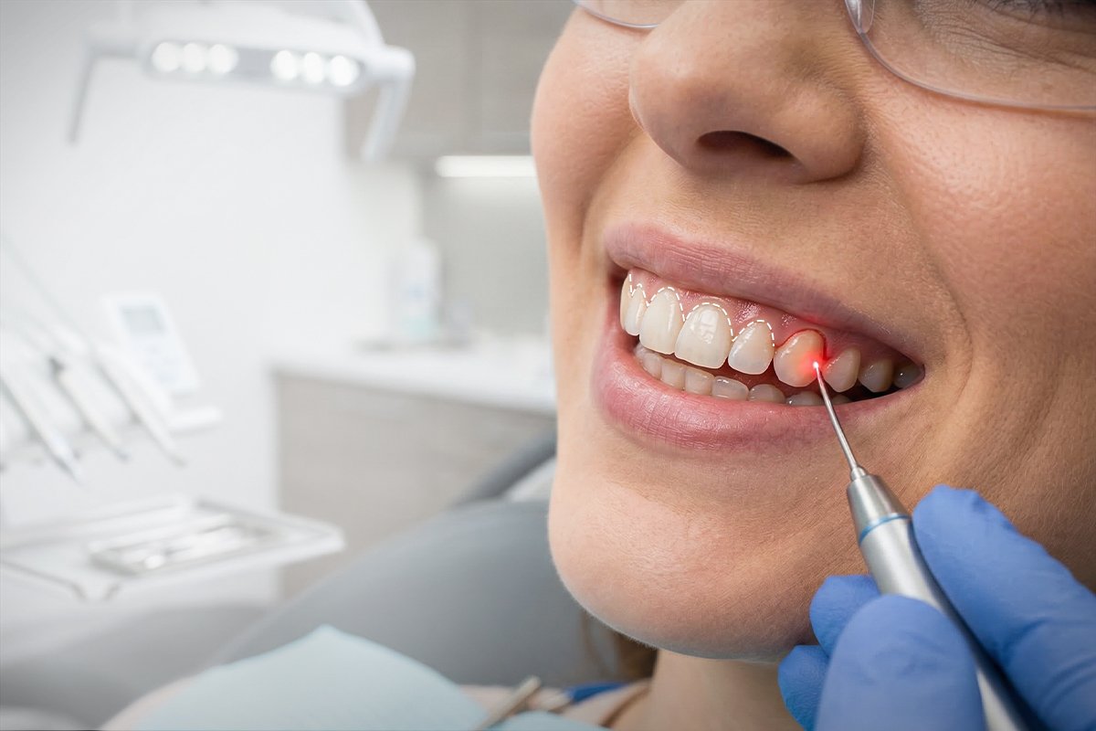Laser Gum Therapy
