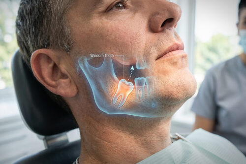 Wisdom Tooth Surgery