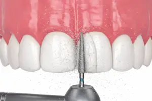 Composite Bonding for Gaps