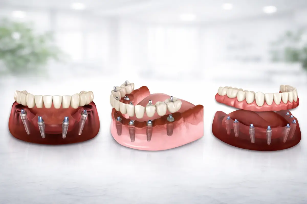 Temporary Teeth After Full-Arch Surgery