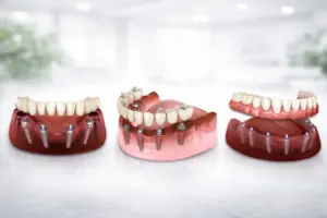 Temporary Teeth After Full-Arch Surgery