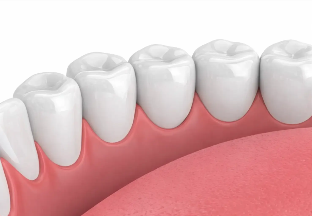 Can You Reverse a Hollywood Smile?