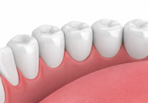 Reversable hollywood smile