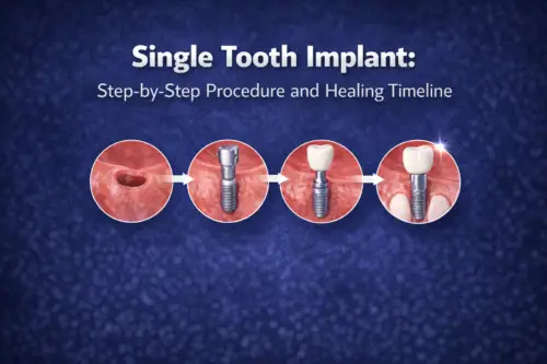 Single Tooth Implant: Step-by-Step Procedure and Healing Timeline