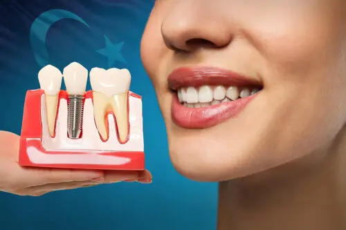 Dental Implant Turkey