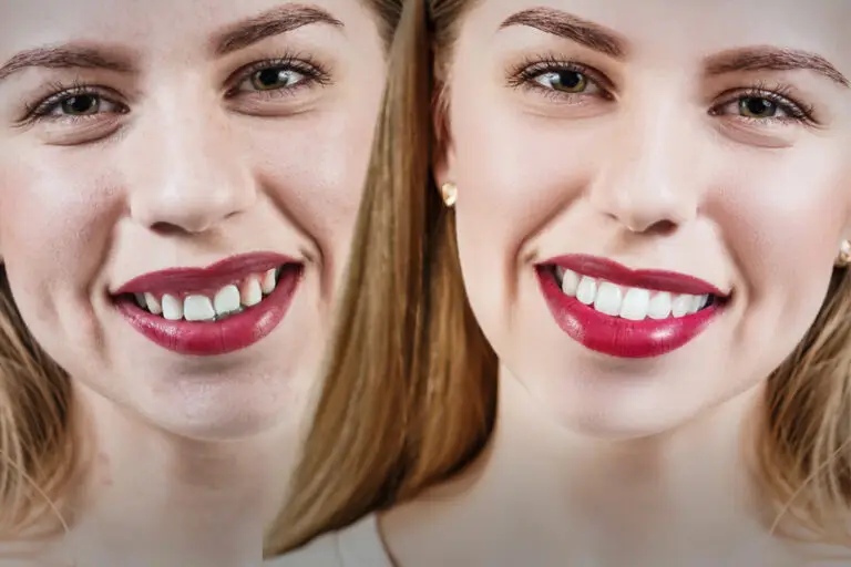 Fixing Uneven Teeth Without Braces