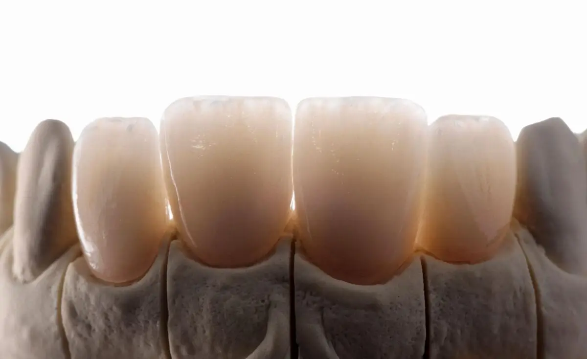 Composite vs Porcelain veneers