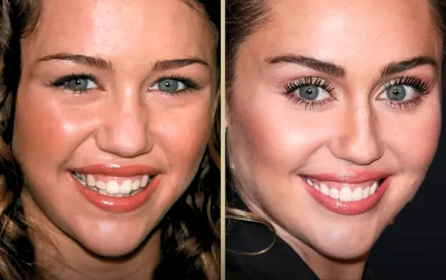 Miley Cyrus Teeth Before and After: Did She Get Veneers?