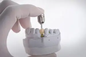 Single Tooth Implant