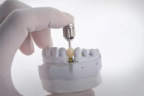 Single Tooth Implant
