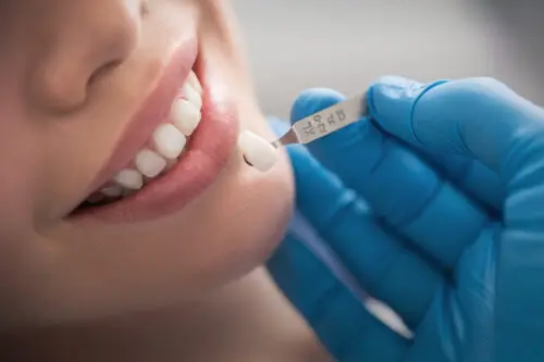 Teeth Colors With Veneers