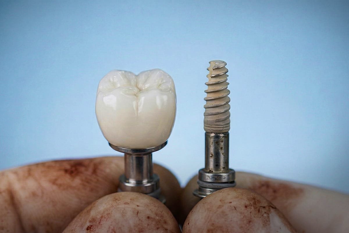Dental implants