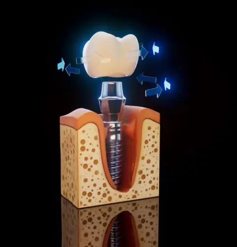 What Should You Eat After a Dental Implant