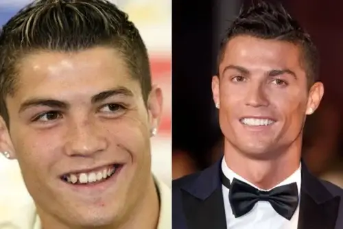 Cristiano Ronaldo Veneers
