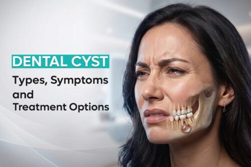 Dental-Cyst