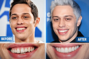 Pete Davidson's Teeth Before & After