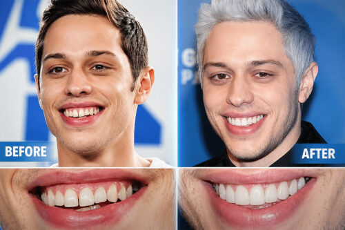 Pete Davidson's Teeth Before & After