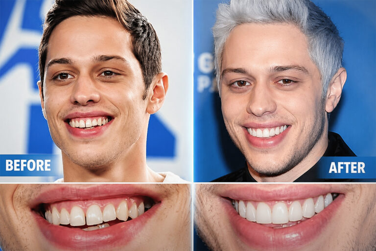 Pete Davidson's Teeth Before & After