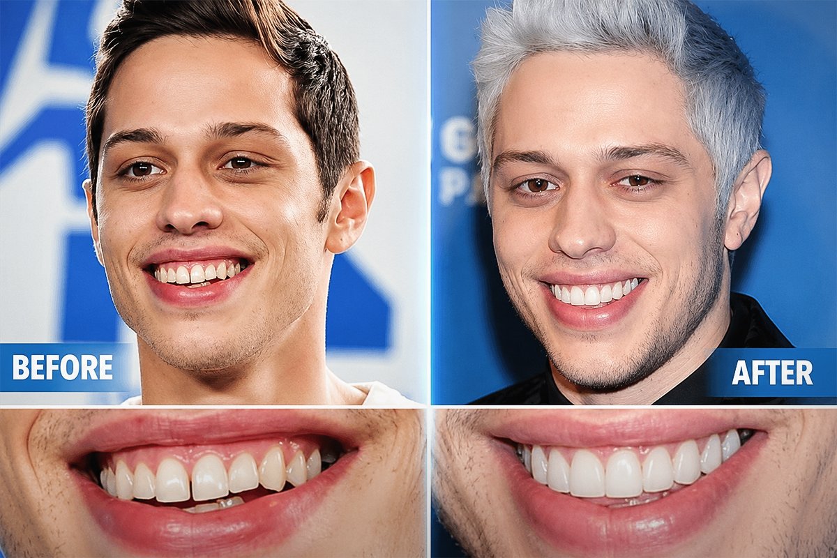 Pete Davidson's Teeth Before & After