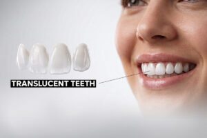 Translucent-Teeth